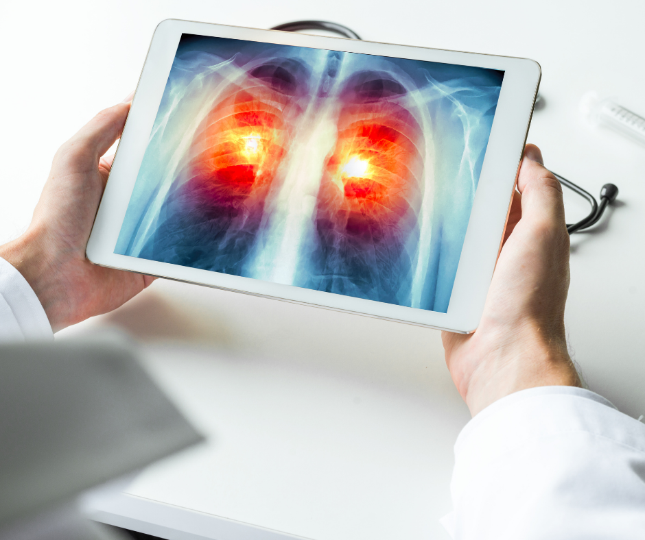 Lung cancer detection possible 10 years prior with ai