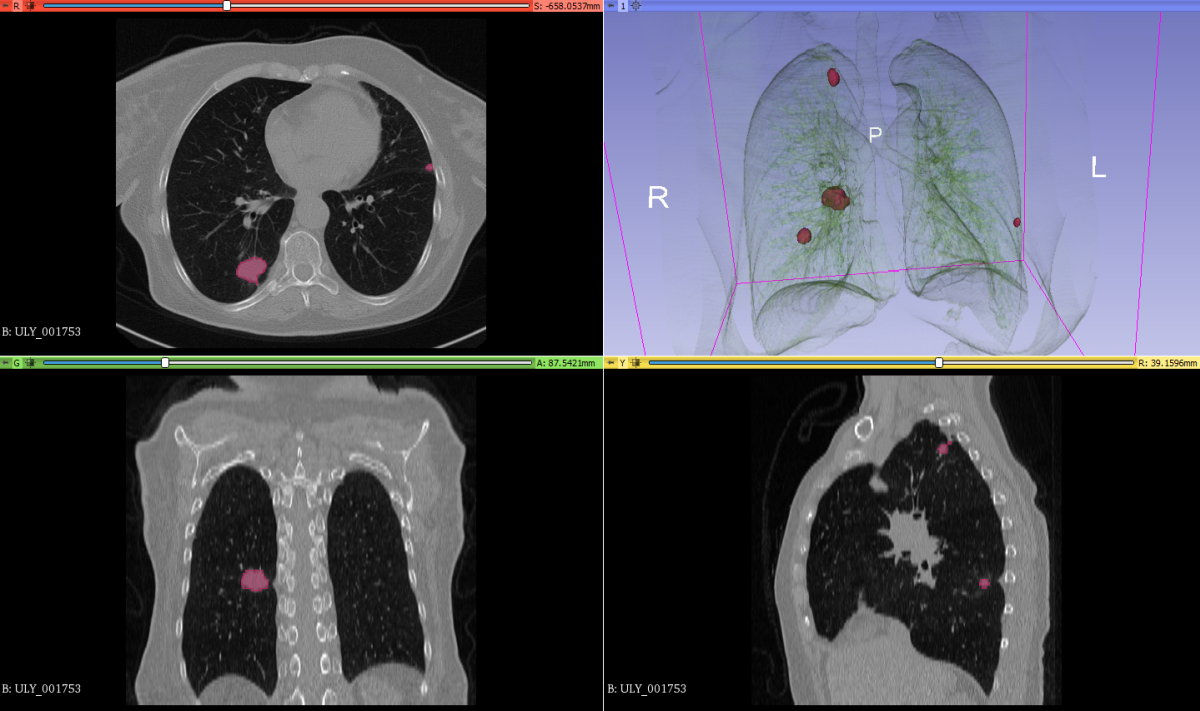 Lung cancer detection possible 10 years prior with ai
