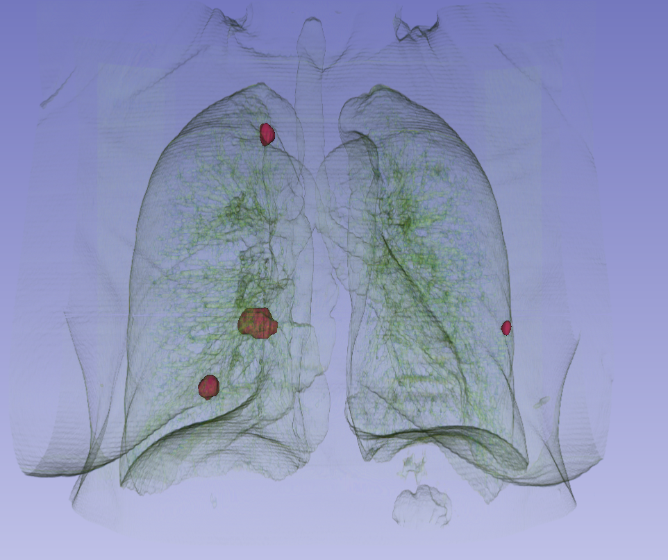 Lung cancer detection possible 10 years prior with ai