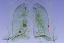 Lung cancer detection possible 10 years prior with ai