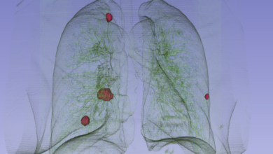 Lung cancer detection possible 10 years prior with ai