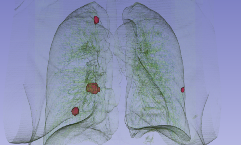 Lung cancer detection possible 10 years prior with ai